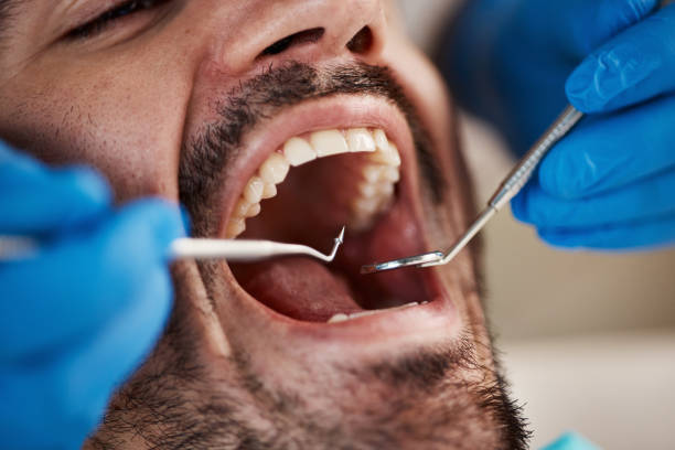Best Emergency Dentist for Lost Fillings or Crowns in Slater, IA